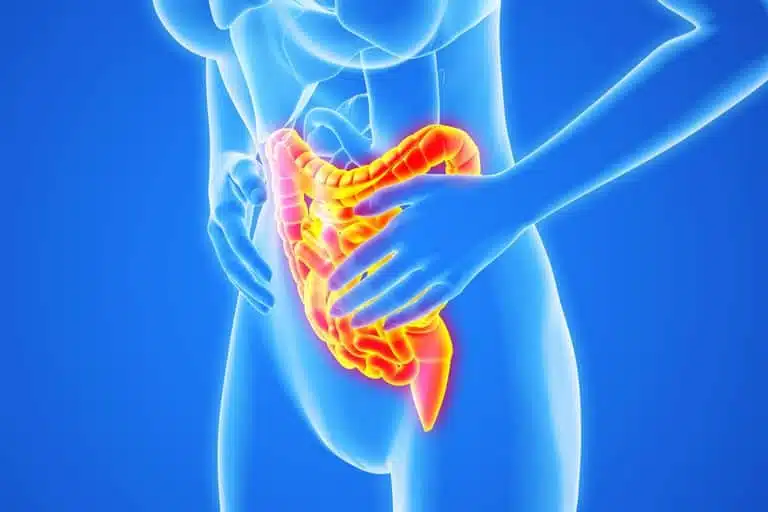 Inflammatory Bowel Disease Flare-up